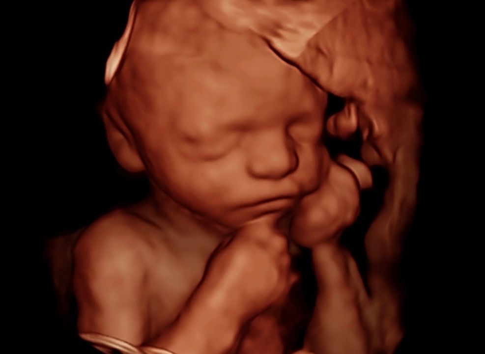 svc1 3d ultrasound r1